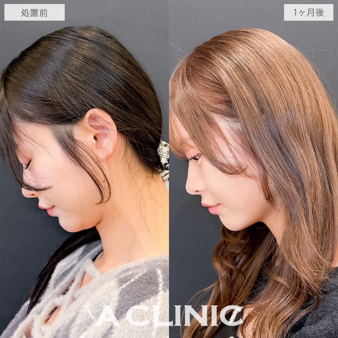 1day小顔脂肪吸引でかわいいを更新しました！こちら処置前と1か月後の症例です(20代女性)