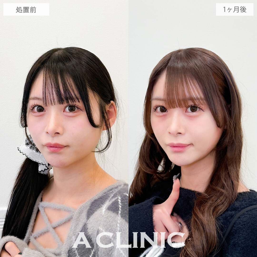 1day小顔脂肪吸引でかわいいを更新しました！こちら処置前と1か月後の症例です(20代女性)