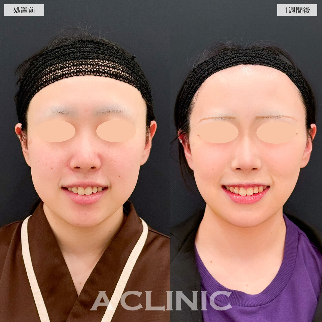 1day小顔脂肪吸引とバッカルファット除去術はたった1週間でこんなに変化を感じられます！こちら処置前と1週間後の症例です(20代女性)