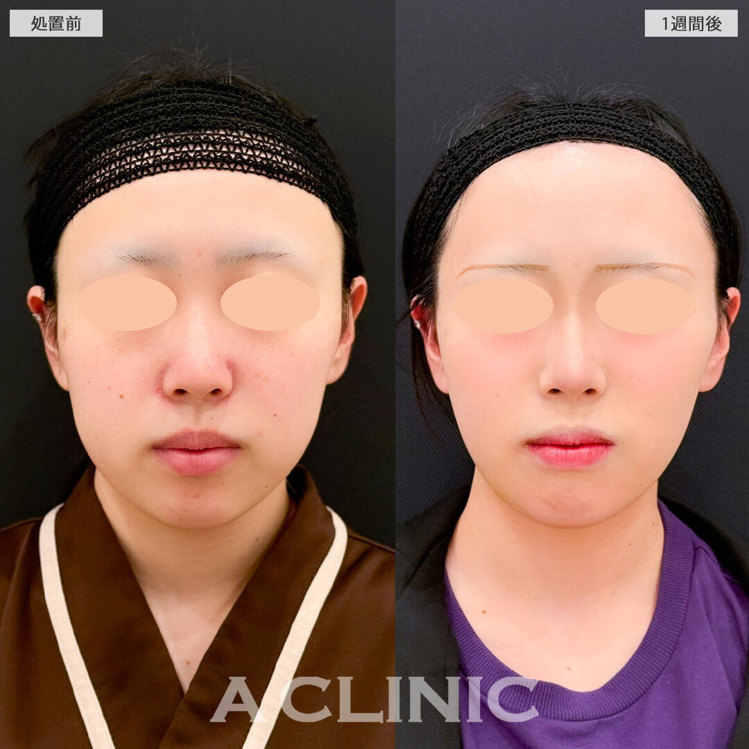 1day小顔脂肪吸引とバッカルファット除去術はたった1週間でこんなに変化を感じられます！こちら処置前と1週間後の症例です(20代女性)