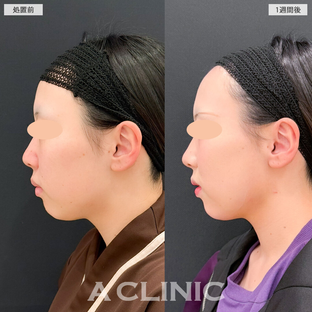 1day小顔脂肪吸引とバッカルファット除去術はたった1週間でこんなに変化を感じられます！こちら処置前と1週間後の症例です(20代女性)