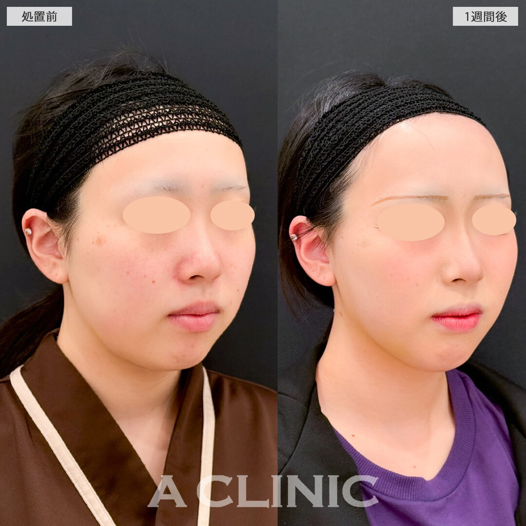 1day小顔脂肪吸引とバッカルファット除去術はたった1週間でこんなに変化を感じられます！こちら処置前と1週間後の症例です(20代女性)