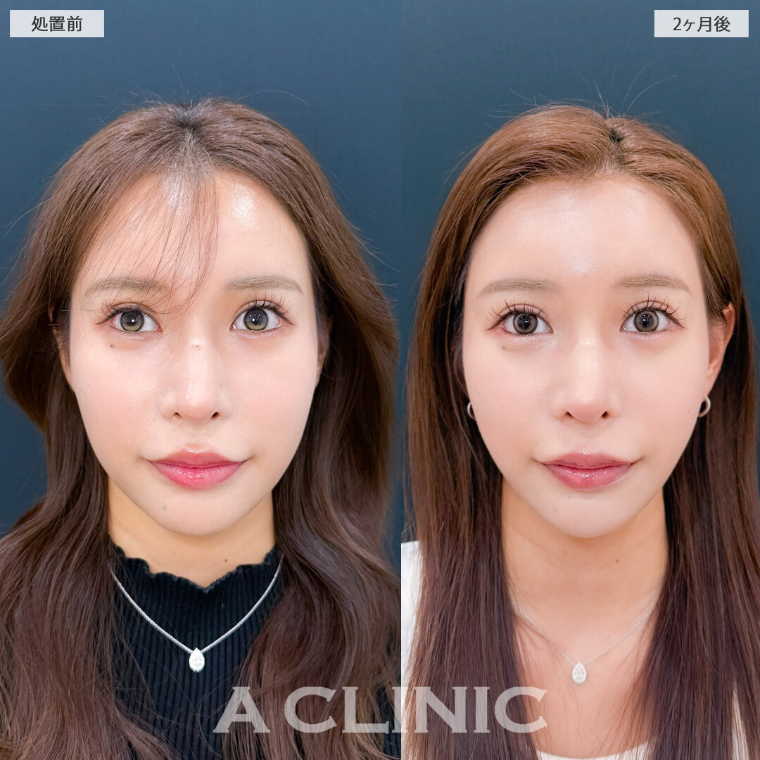 1day小顔脂肪吸引で余分な脂肪がなくなってさらに小顔美人に！こちら処置前と2ヶ月後の症例です(20代女性)