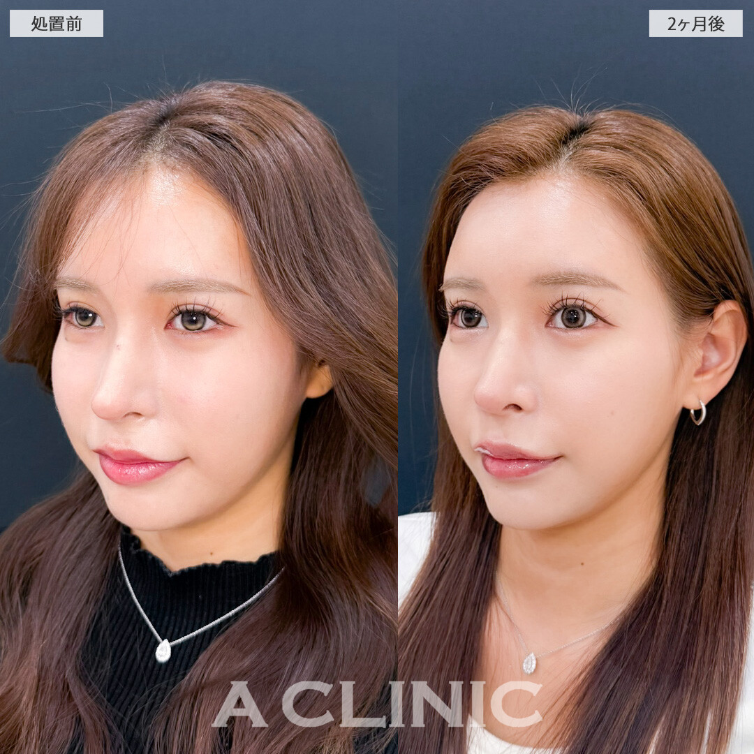 1day小顔脂肪吸引で余分な脂肪がなくなってさらに小顔美人に！こちら処置前と2ヶ月後の症例です(20代女性)