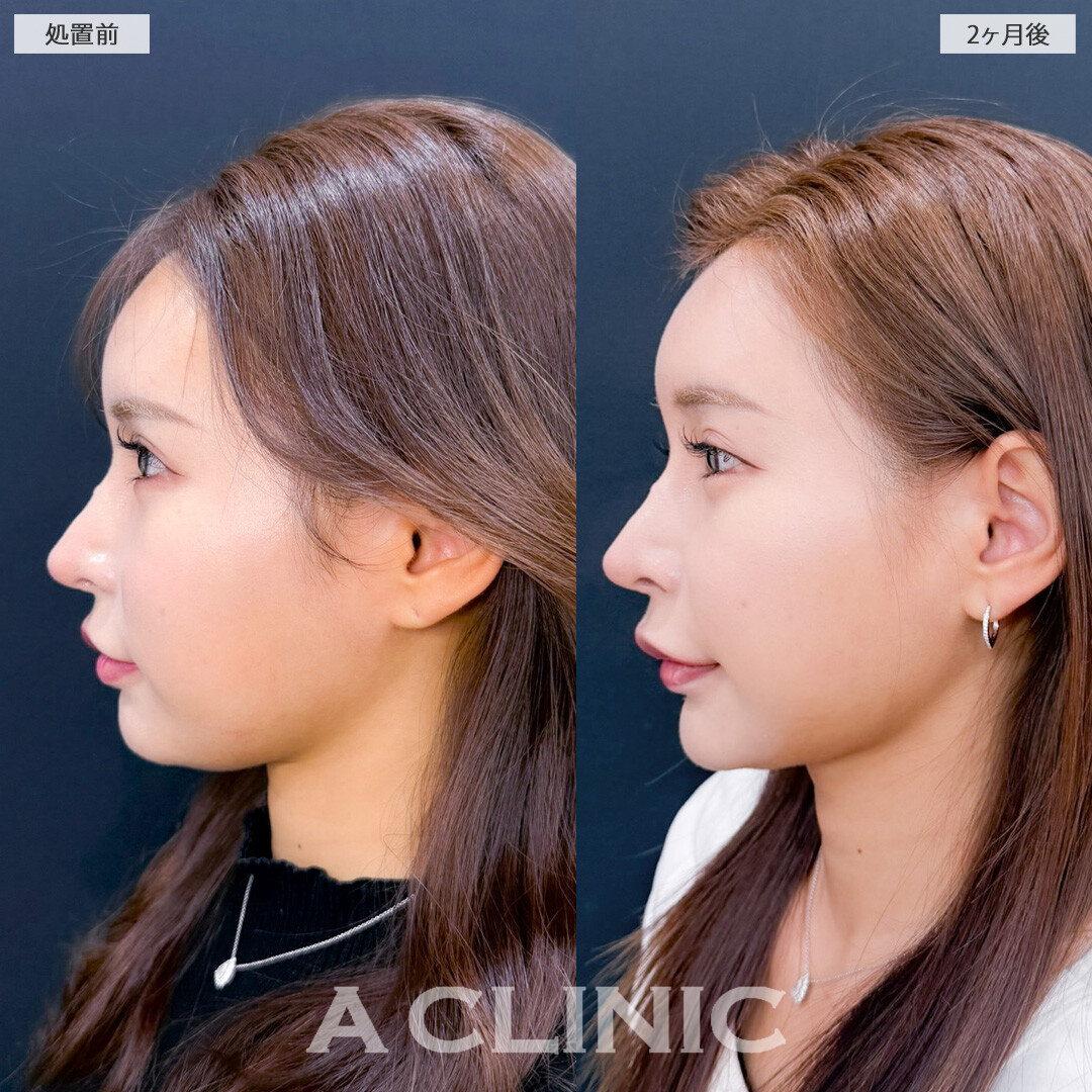 1day小顔脂肪吸引で余分な脂肪がなくなってさらに小顔美人に！こちら処置前と2ヶ月後の症例です(20代女性)