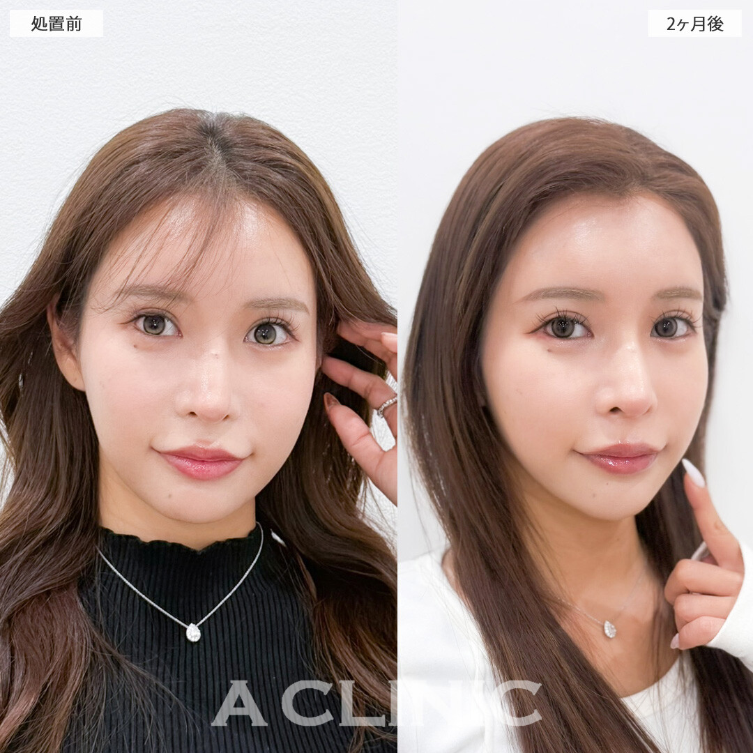 1day小顔脂肪吸引で余分な脂肪がなくなってさらに小顔美人に！こちら処置前と2ヶ月後の症例です(20代女性)