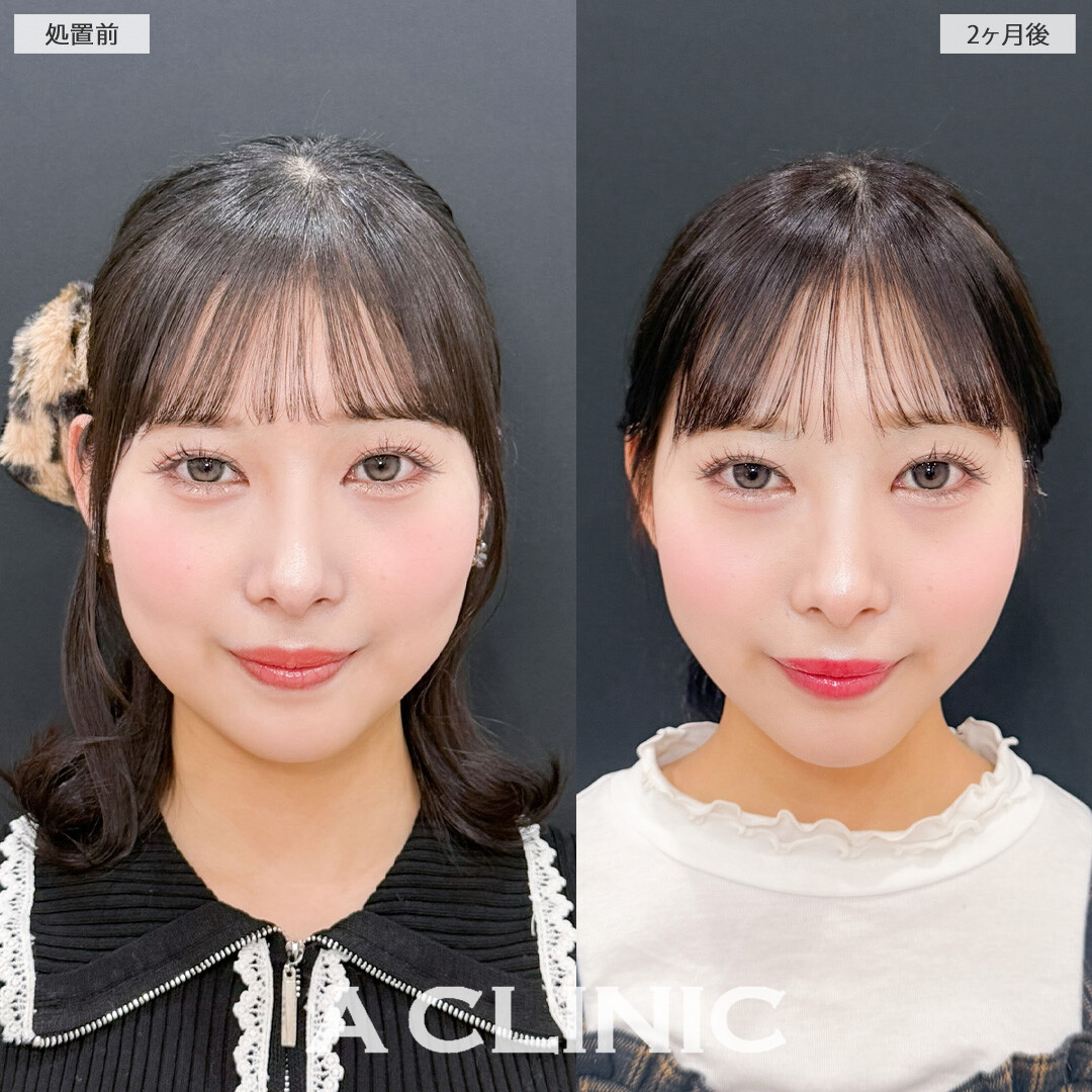 1day小顔脂肪吸引で輪郭が綺麗になって首も長く見えるようになりました！こちら処置前と2ヶ月後の症例です(20代女性)