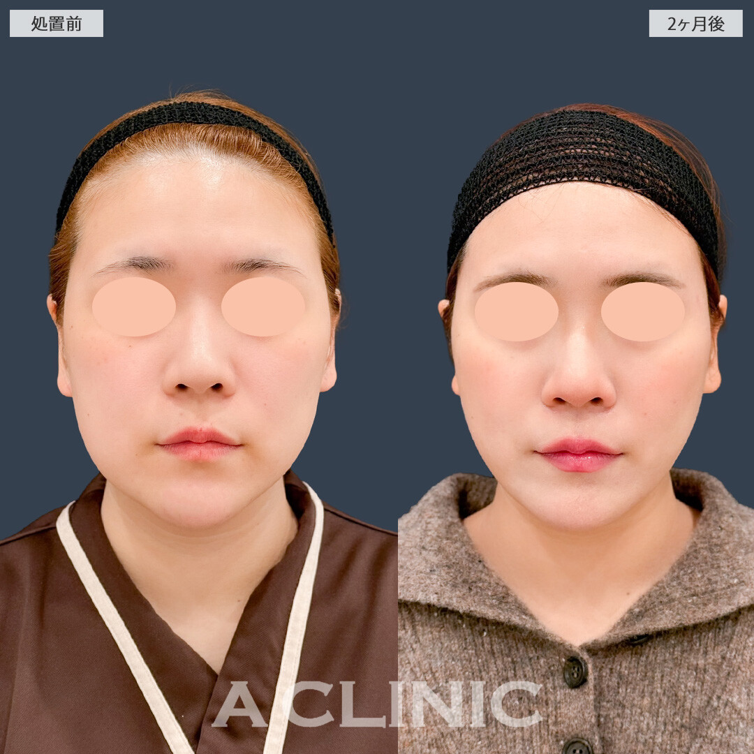 1day小顔脂肪吸引でお顔の重心がギュッとあがりました！こちら処置前と2ヶ月後の症例です(20代女性)