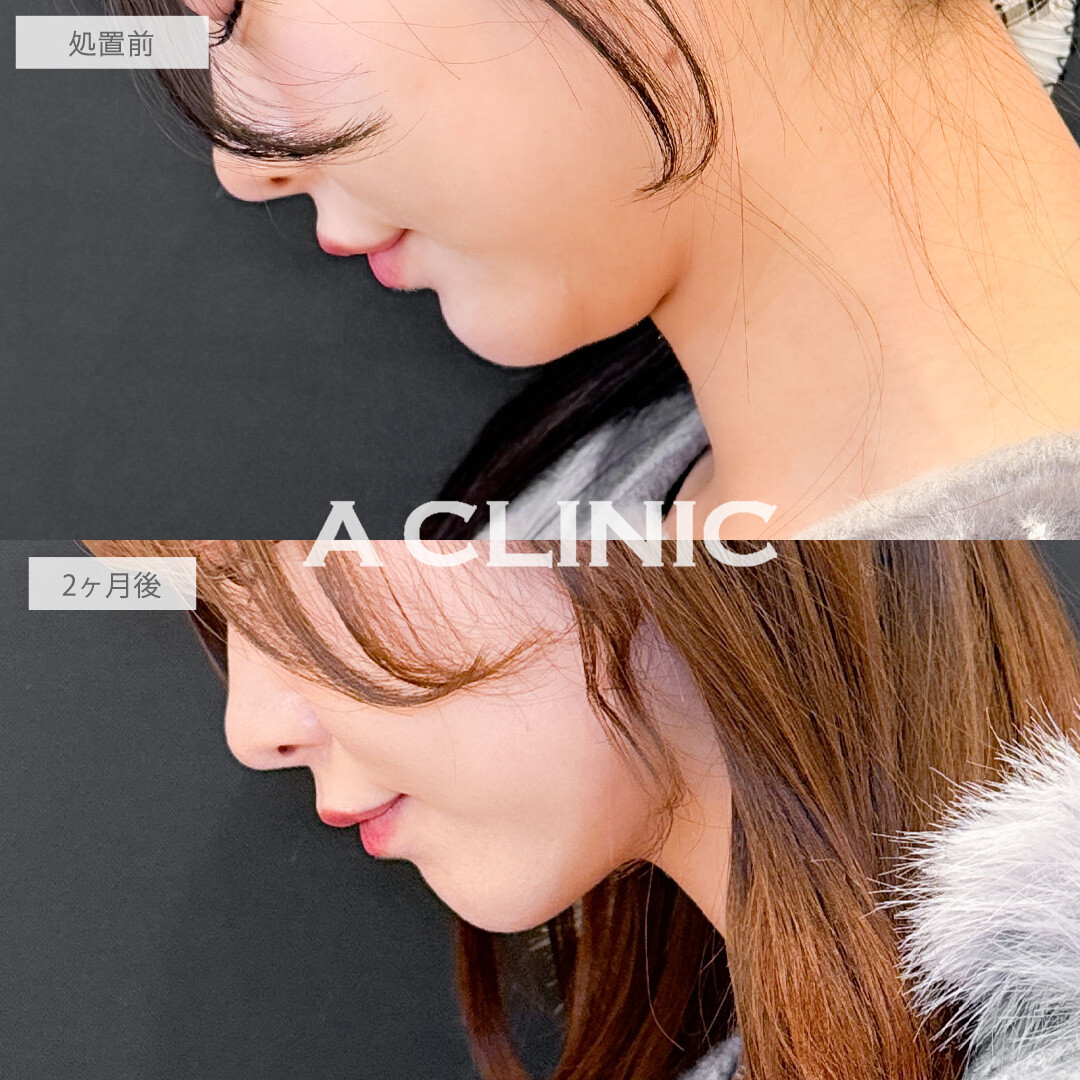 1day小顔脂肪吸引で丸顔さんもしっかりシャープになりました！こちら処置前と2ヶ月後の症例です(20代女性)