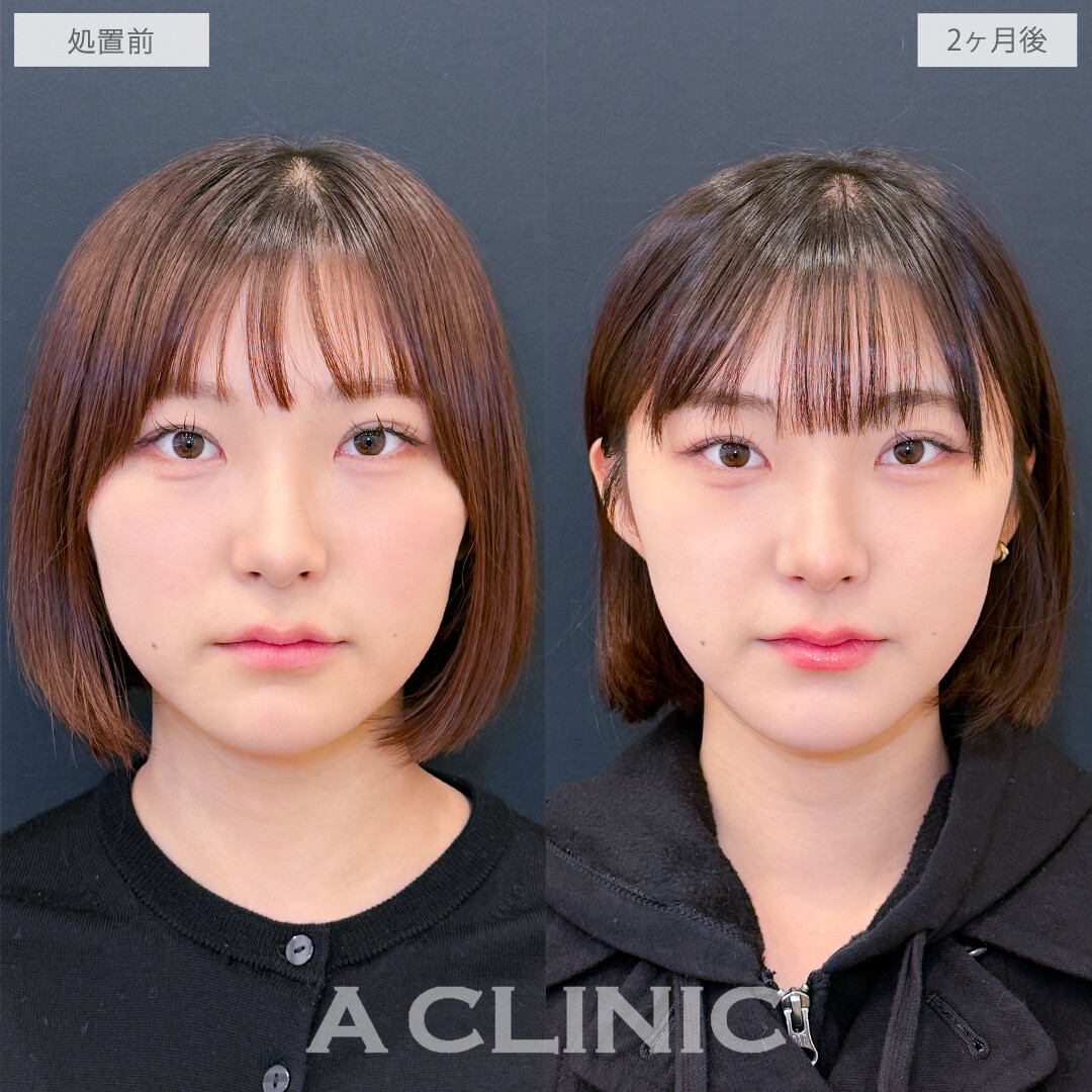 1day小顔脂肪吸引でどこから見ても美しいVフェイスが爆誕！こちら処置前と2ヶ月後の症例です(20代女性)