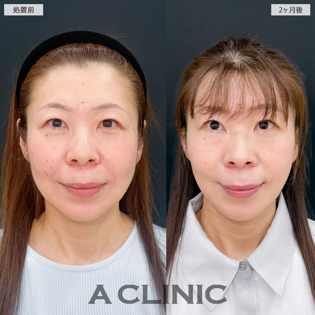 1day小顔脂肪吸引とA式美肌たるみ切開で余分なたるみと脂肪を一掃していつまでも若々しく！こちら処置前と2ヶ月後の症例です(50代女性)