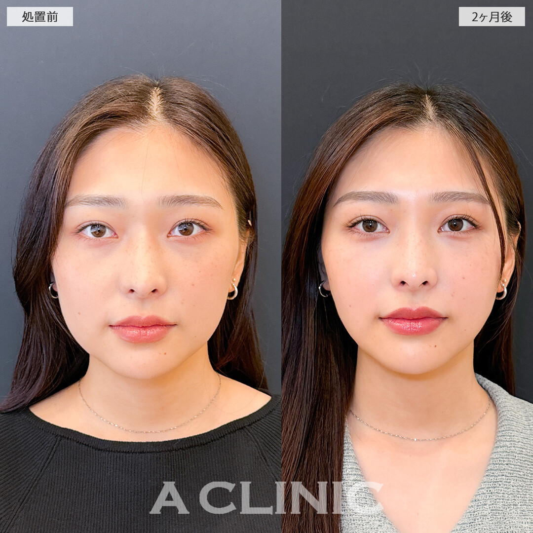 1day小顔脂肪吸引でフェイスラインが整い垢抜け大成功！こちら処置前と2ヶ月後の症例です(20代女性)