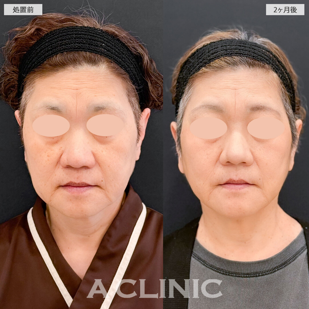 1day小顔脂肪吸引で顔の下半分を持ち上げさりげなく若返り！こちら処置前と2ヶ月後の症例です(50代女性)