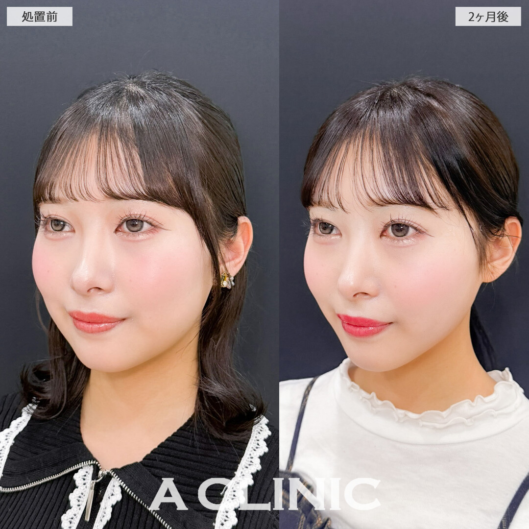 1day小顔脂肪吸引で輪郭が綺麗になって首も長く見えるようになりました！こちら処置前と2ヶ月後の症例です(20代女性)