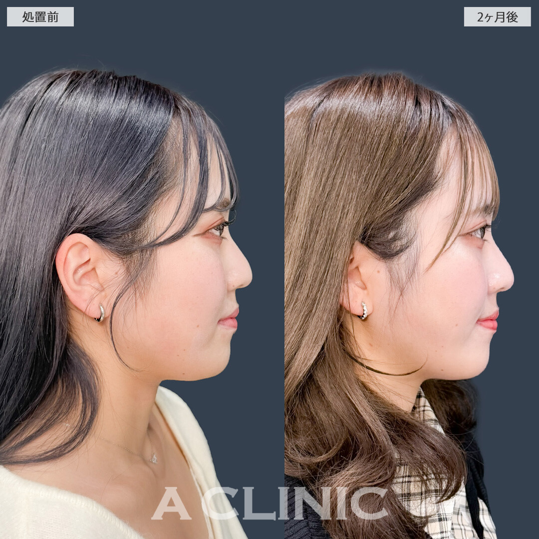 1day小顔脂肪吸引であご下のお肉とさよならできました！こちら処置前と2ヶ月後の症例です(20代女性)