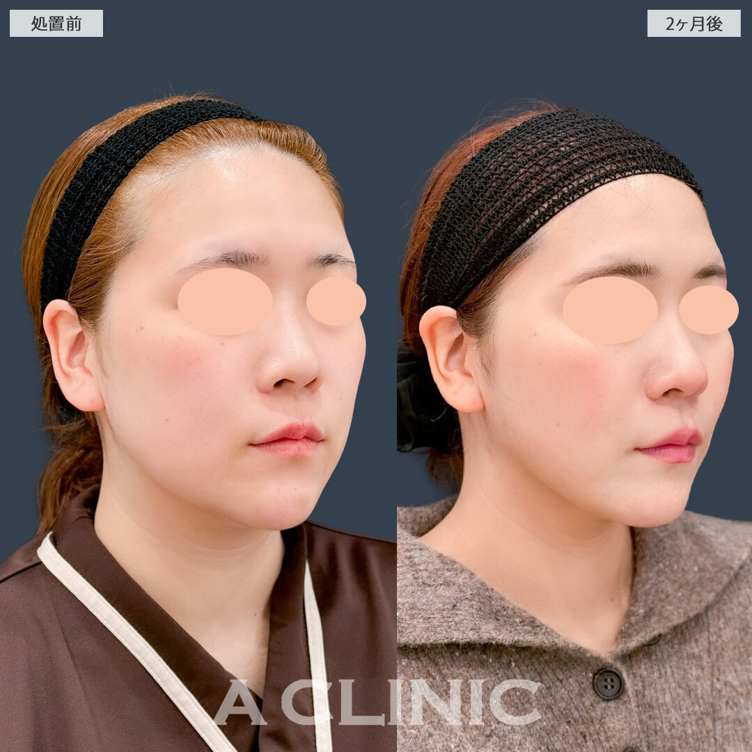 1day小顔脂肪吸引でお顔の重心がギュッとあがりました！こちら処置前と2ヶ月後の症例です(20代女性)