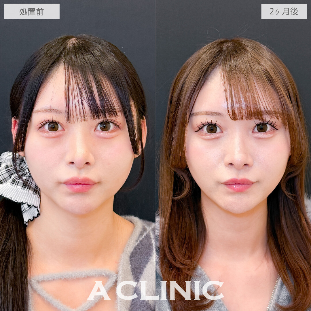 1day小顔脂肪吸引で丸顔さんもしっかりシャープになりました！こちら処置前と2ヶ月後の症例です(20代女性)