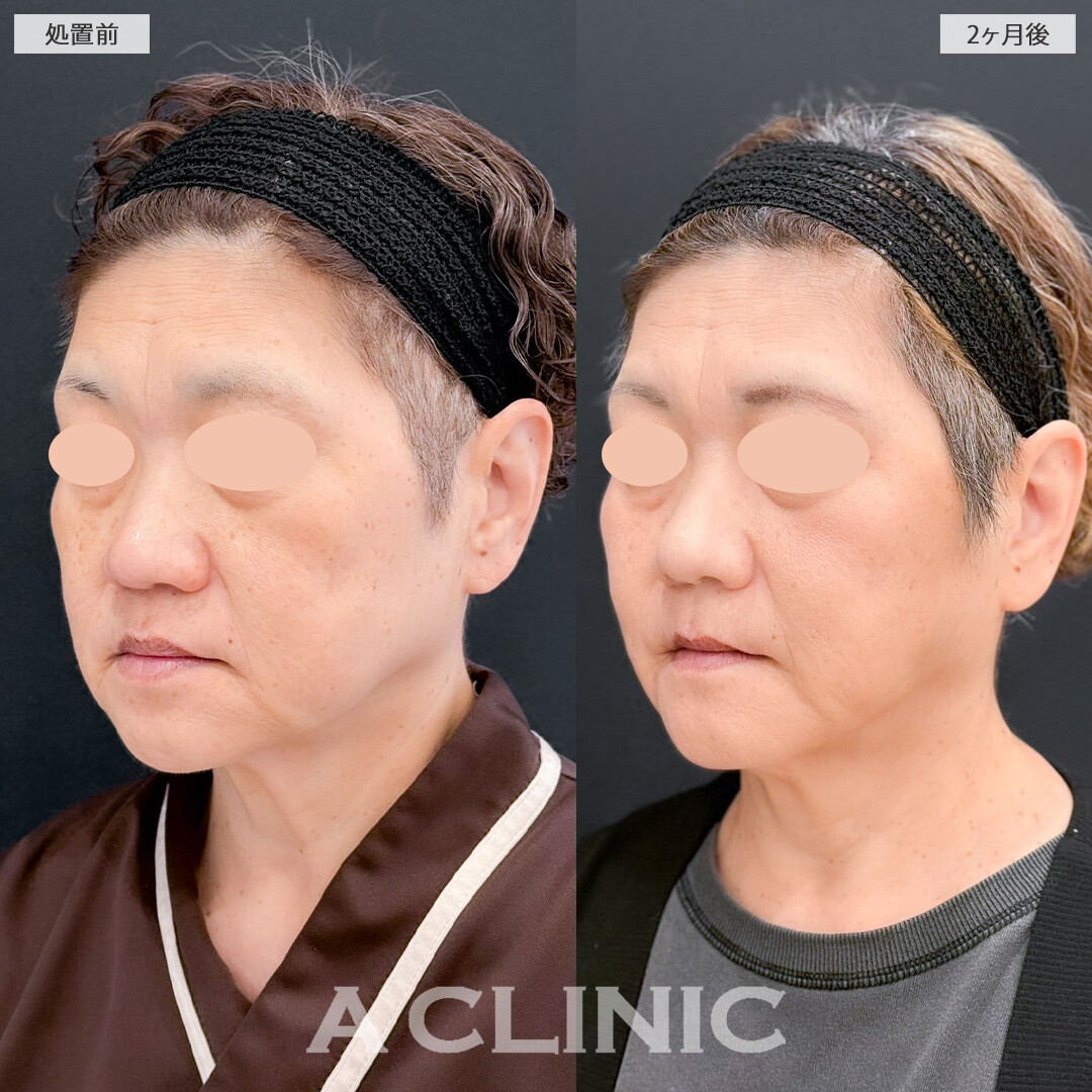 1day小顔脂肪吸引で顔の下半分を持ち上げさりげなく若返り！こちら処置前と2ヶ月後の症例です(50代女性)