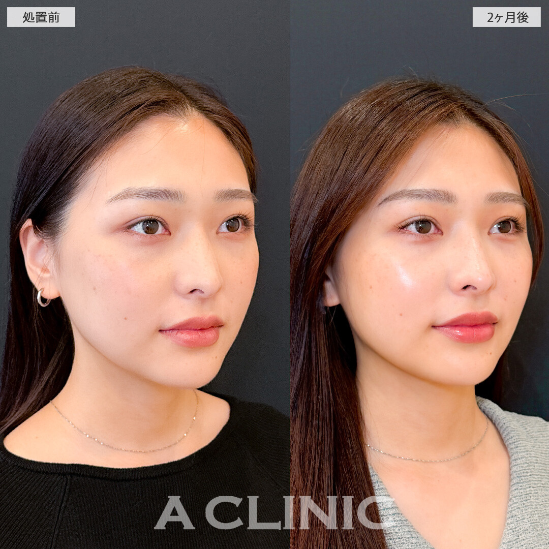 1day小顔脂肪吸引でフェイスラインが整い垢抜け大成功！こちら処置前と2ヶ月後の症例です(20代女性)