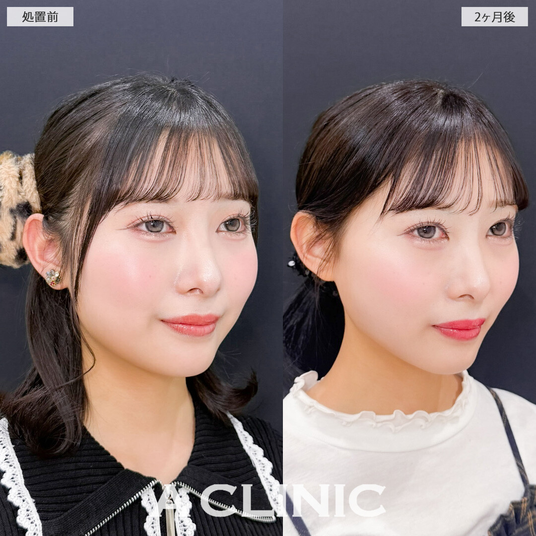 1day小顔脂肪吸引で輪郭が綺麗になって首も長く見えるようになりました！こちら処置前と2ヶ月後の症例です(20代女性)