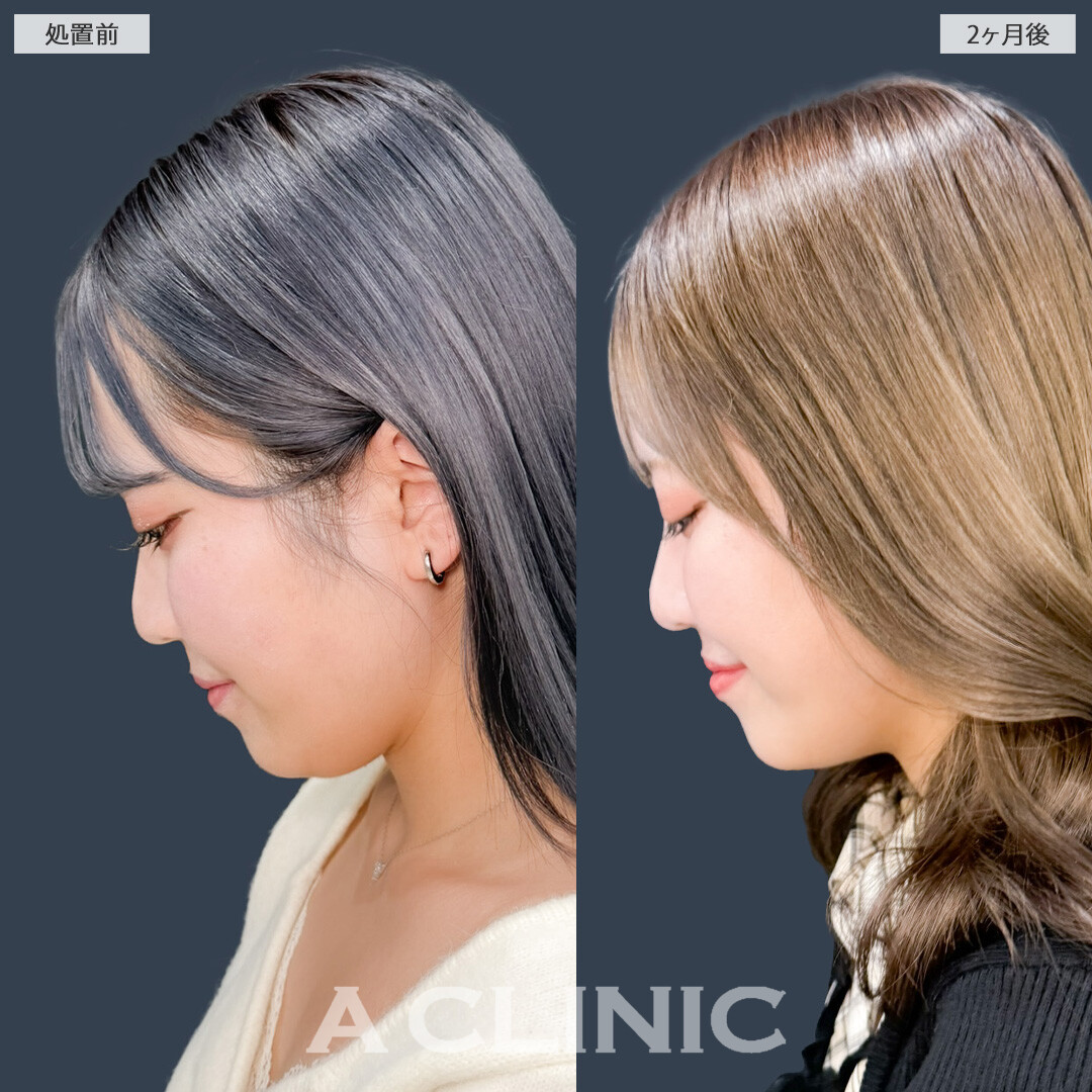 1day小顔脂肪吸引であご下のお肉とさよならできました！こちら処置前と2ヶ月後の症例です(20代女性)