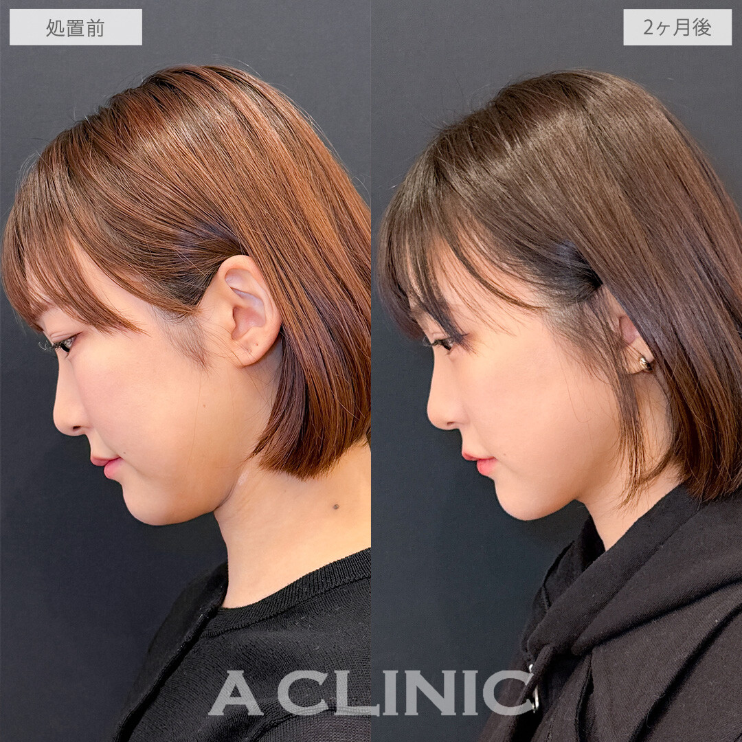 1day小顔脂肪吸引でどこから見ても美しいVフェイスが爆誕！こちら処置前と2ヶ月後の症例です(20代女性)