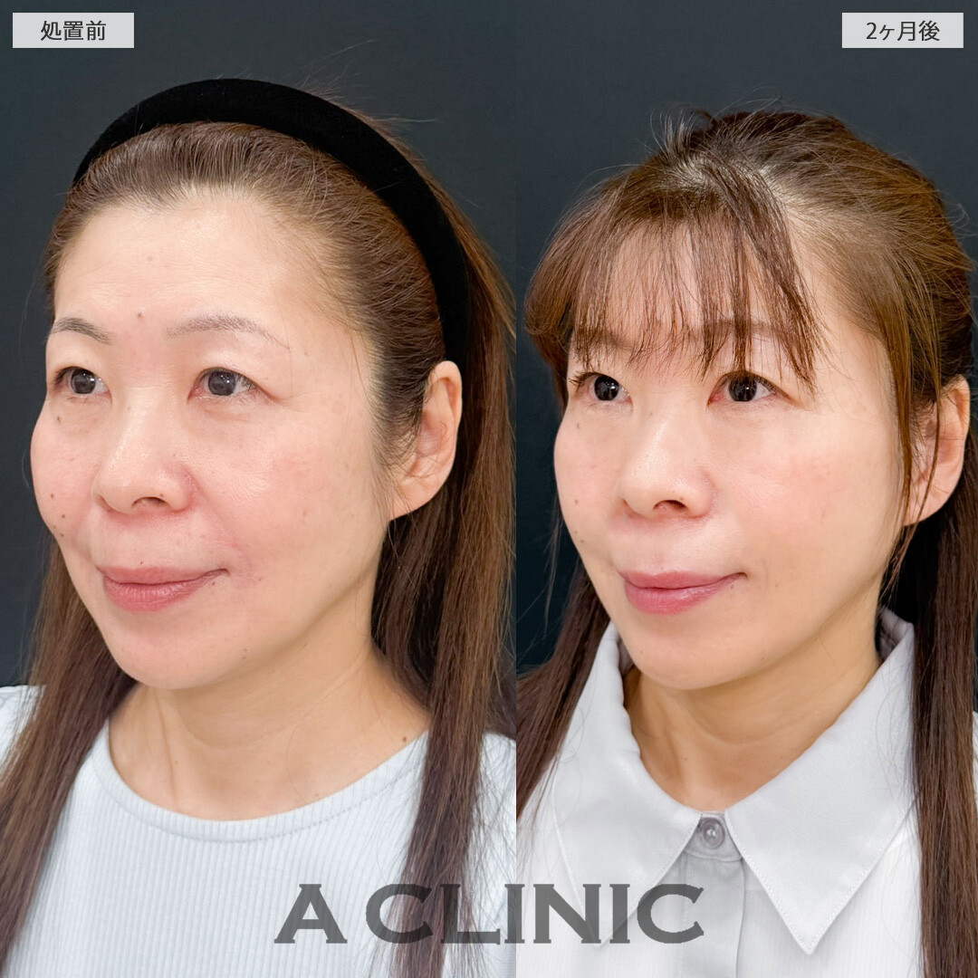 1day小顔脂肪吸引とA式美肌たるみ切開で余分なたるみと脂肪を一掃していつまでも若々しく！こちら処置前と2ヶ月後の症例です(50代女性)