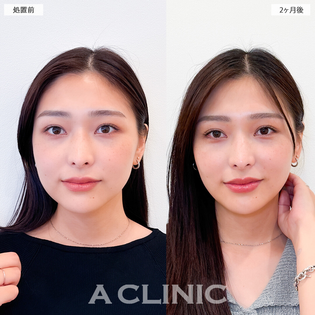 1day小顔脂肪吸引でフェイスラインが整い垢抜け大成功！こちら処置前と2ヶ月後の症例です(20代女性)