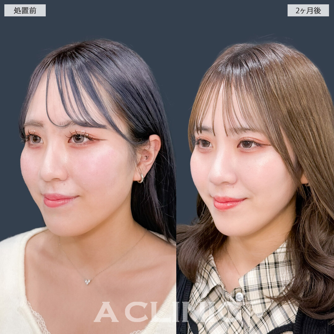 1day小顔脂肪吸引であご下のお肉とさよならできました！こちら処置前と2ヶ月後の症例です(20代女性)
