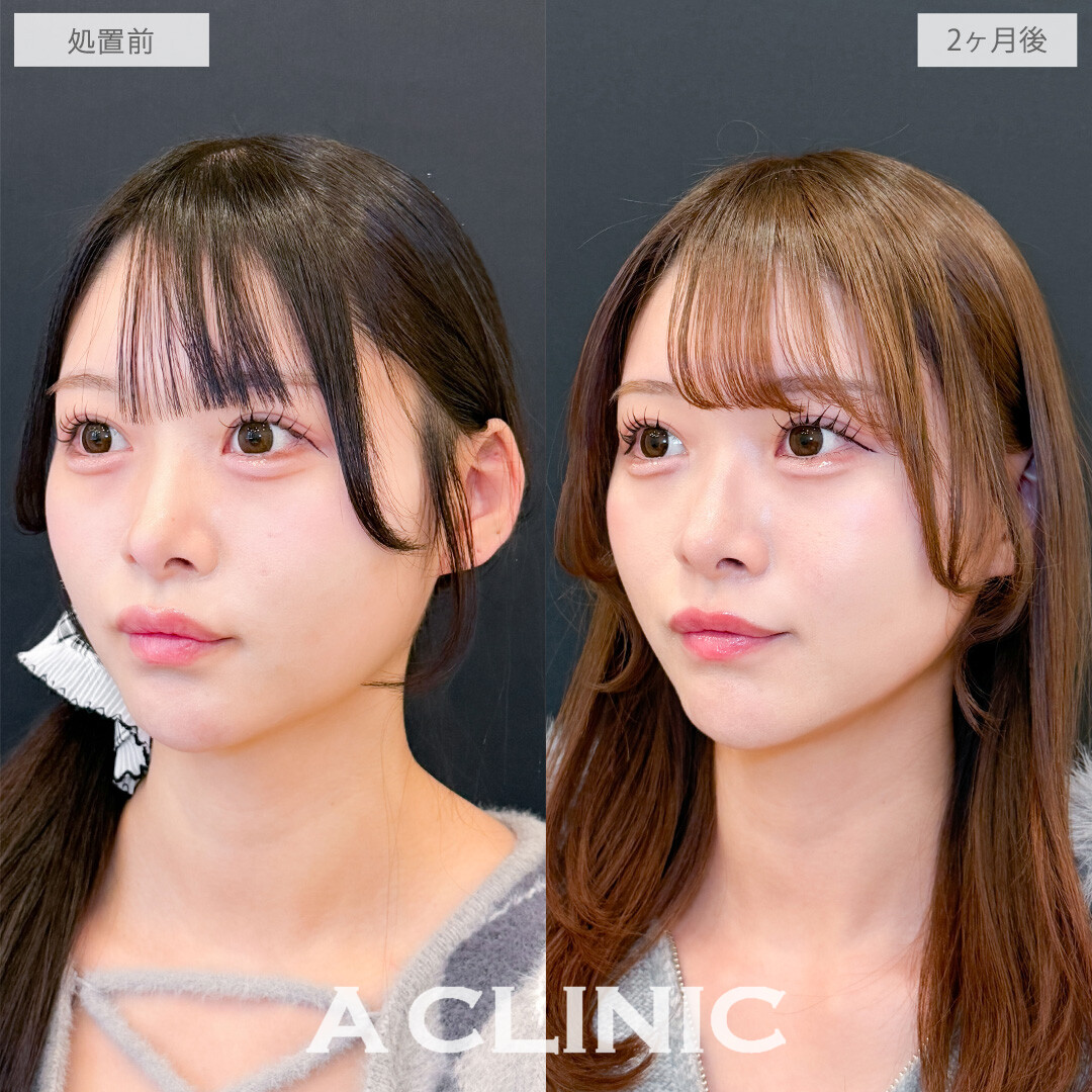 1day小顔脂肪吸引で丸顔さんもしっかりシャープになりました！こちら処置前と2ヶ月後の症例です(20代女性)