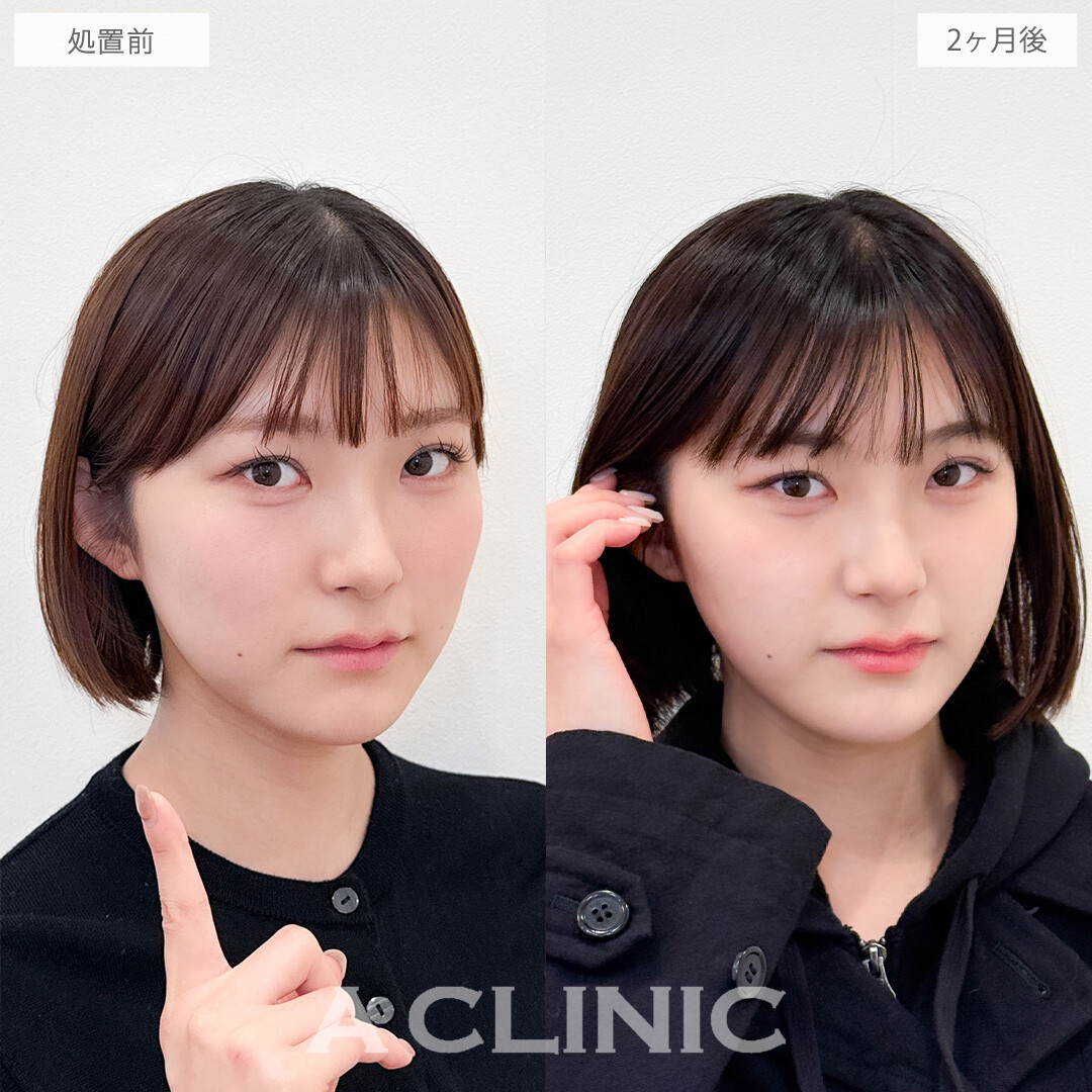 1day小顔脂肪吸引でどこから見ても美しいVフェイスが爆誕！こちら処置前と2ヶ月後の症例です(20代女性)