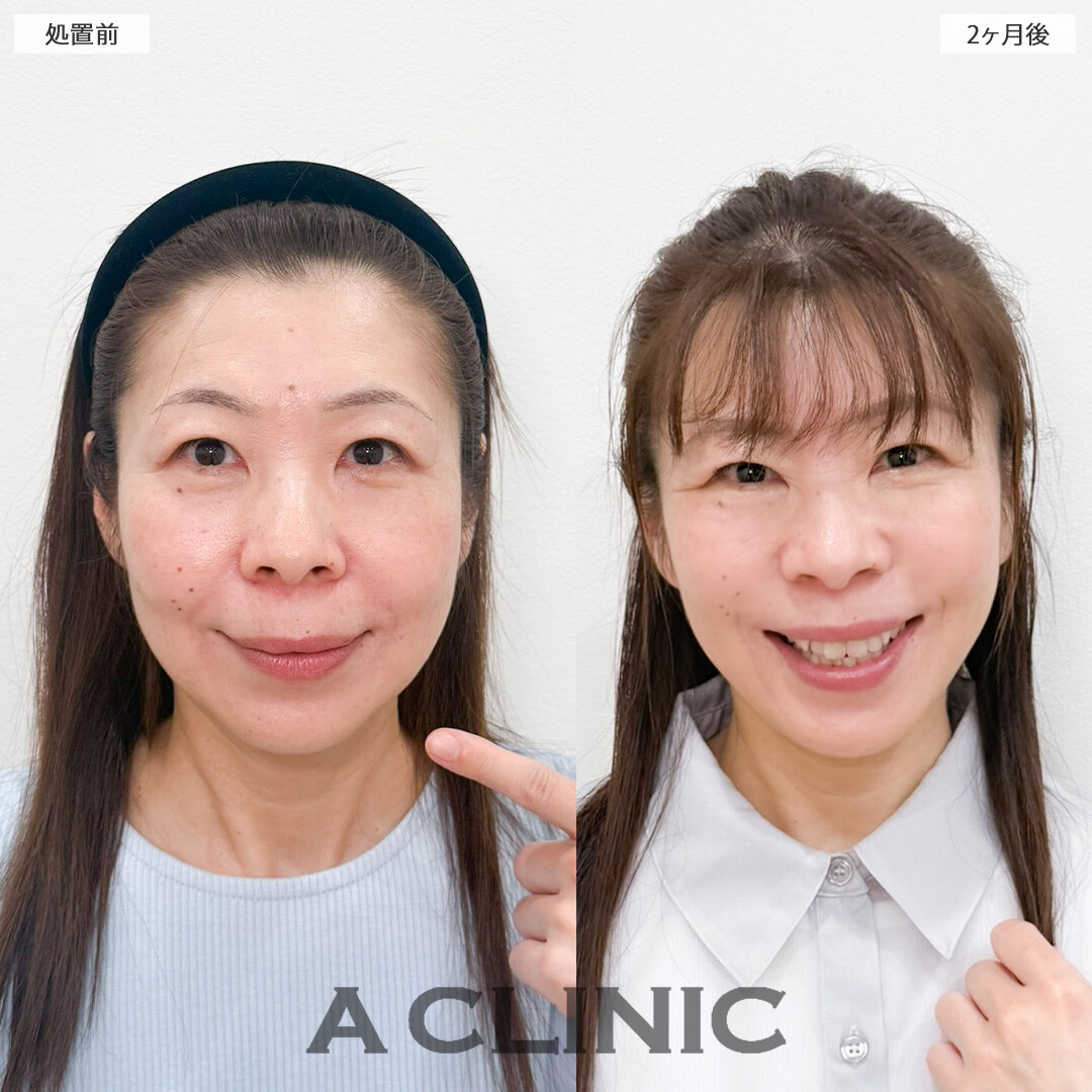 1day小顔脂肪吸引とA式美肌たるみ切開で余分なたるみと脂肪を一掃していつまでも若々しく！こちら処置前と2ヶ月後の症例です(50代女性)