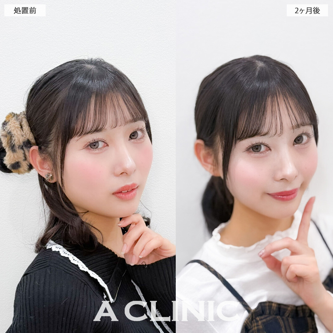 1day小顔脂肪吸引で輪郭が綺麗になって首も長く見えるようになりました！こちら処置前と2ヶ月後の症例です(20代女性)