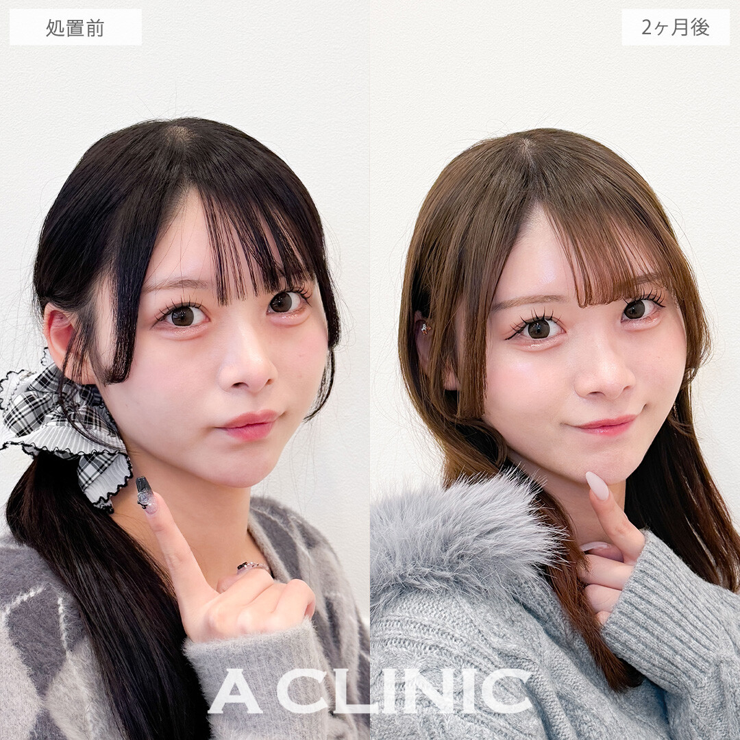 1day小顔脂肪吸引で丸顔さんもしっかりシャープになりました！こちら処置前と2ヶ月後の症例です(20代女性)