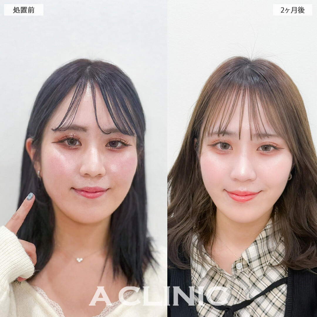 1day小顔脂肪吸引であご下のお肉とさよならできました！こちら処置前と2ヶ月後の症例です(20代女性)