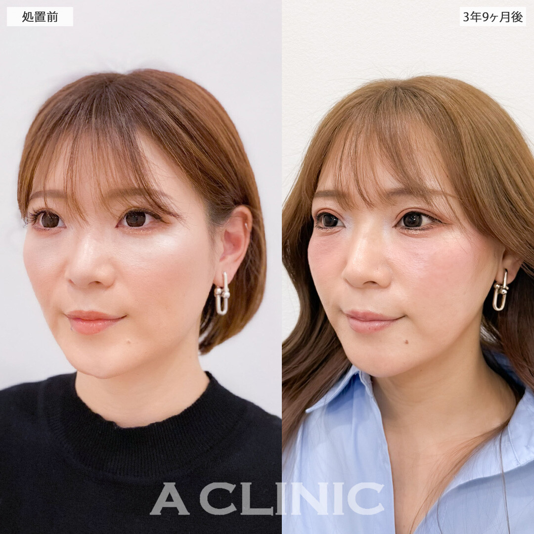 1day小顔脂肪吸引は3年半経っても効果が持続して永久小顔に！こちら処置前と3年9ヶ月後の症例です(30代女性)