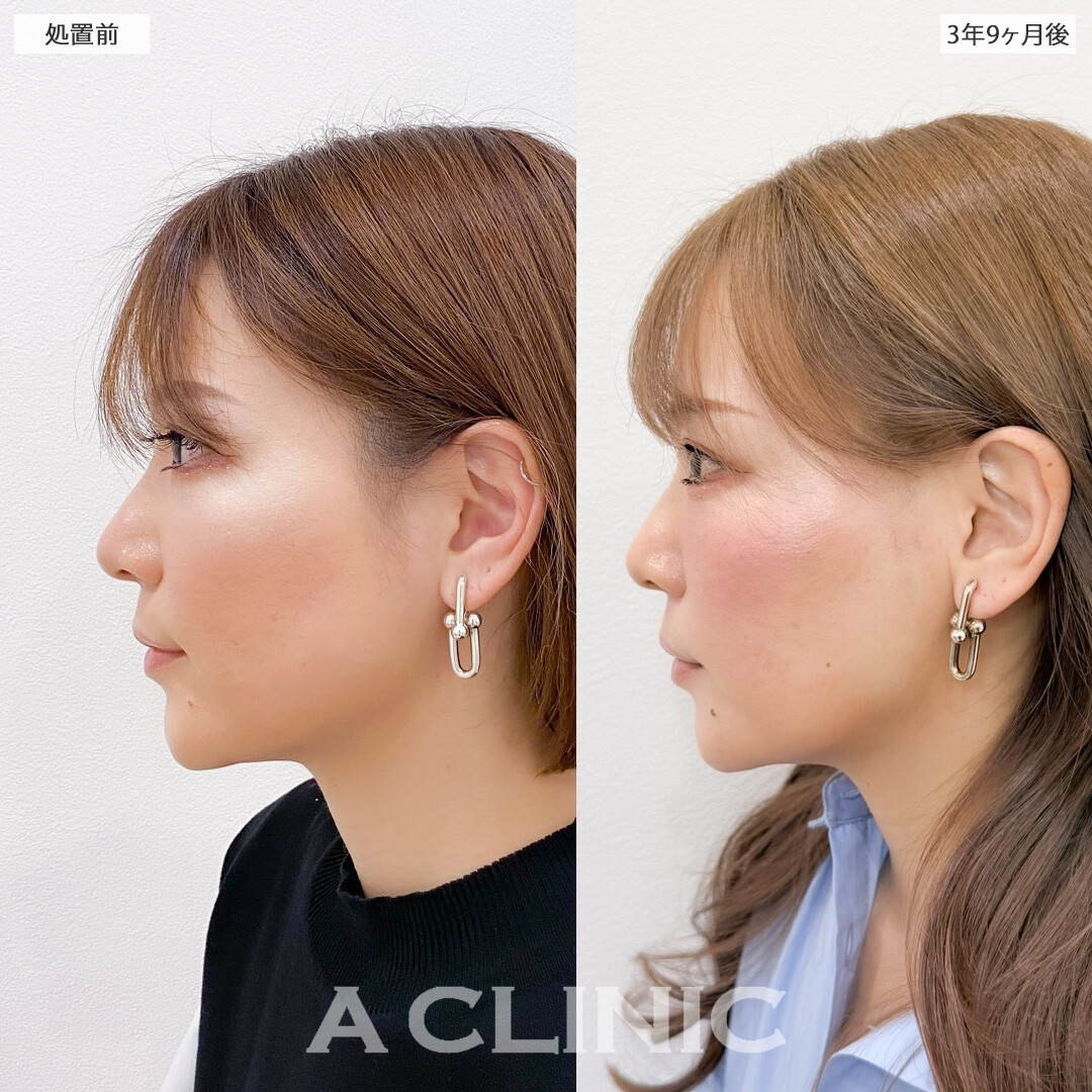 1day小顔脂肪吸引は3年半経っても効果が持続して永久小顔に！こちら処置前と3年9ヶ月後の症例です(30代女性)