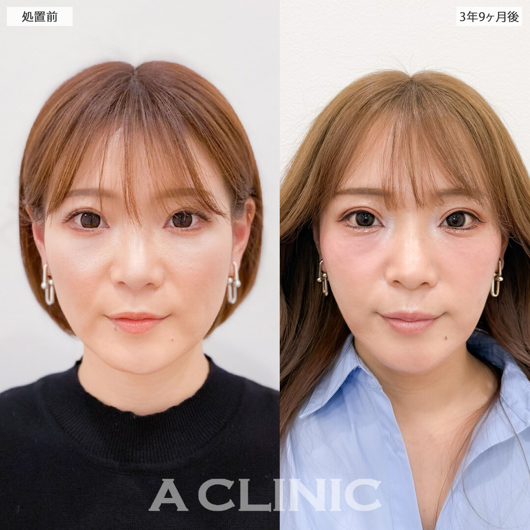 1day小顔脂肪吸引は3年半経っても効果が持続して永久小顔に！こちら処置前と3年9ヶ月後の症例です(30代女性)