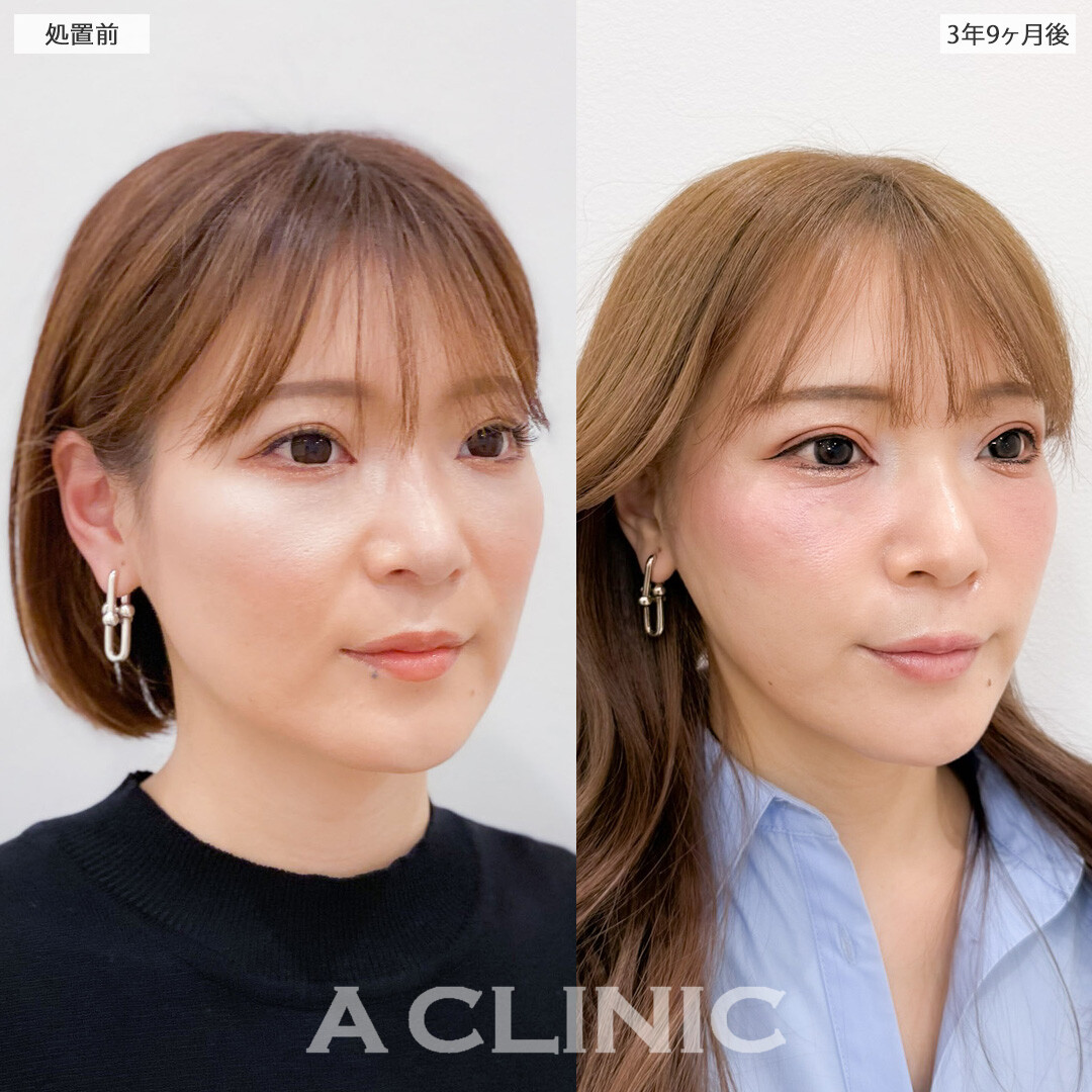 1day小顔脂肪吸引は3年半経っても効果が持続して永久小顔に！こちら処置前と3年9ヶ月後の症例です(30代女性)