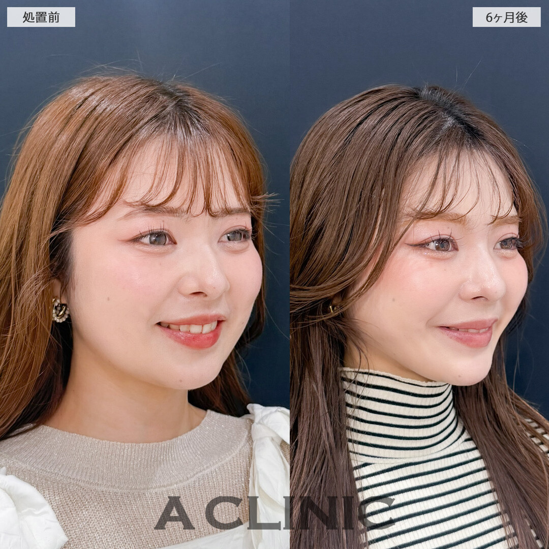 1day小顔脂肪吸引とバッカルファット除去術で永久不滅の小顔が完成しました！こちら処置前と6ヶ月後の症例です(20代女性)