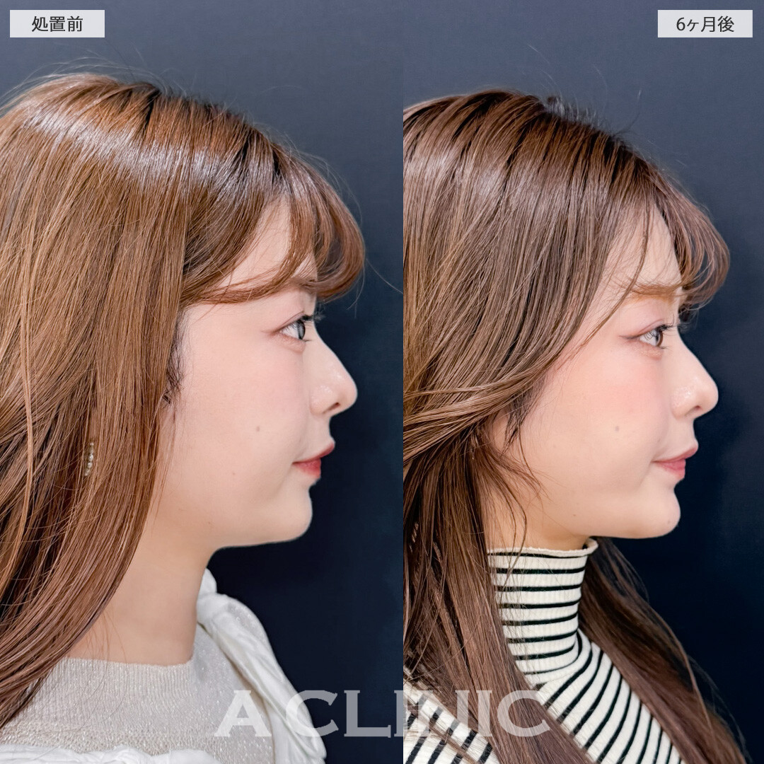 1day小顔脂肪吸引とバッカルファット除去術で永久不滅の小顔が完成しました！こちら処置前と6ヶ月後の症例です(20代女性)