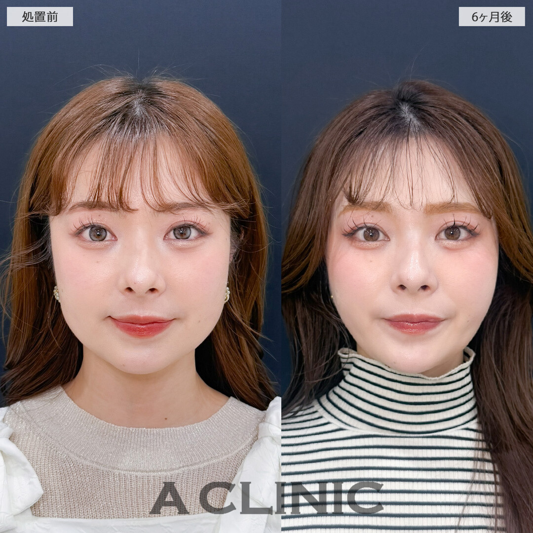 1day小顔脂肪吸引とバッカルファット除去術で永久不滅の小顔が完成しました！こちら処置前と6ヶ月後の症例です(20代女性)