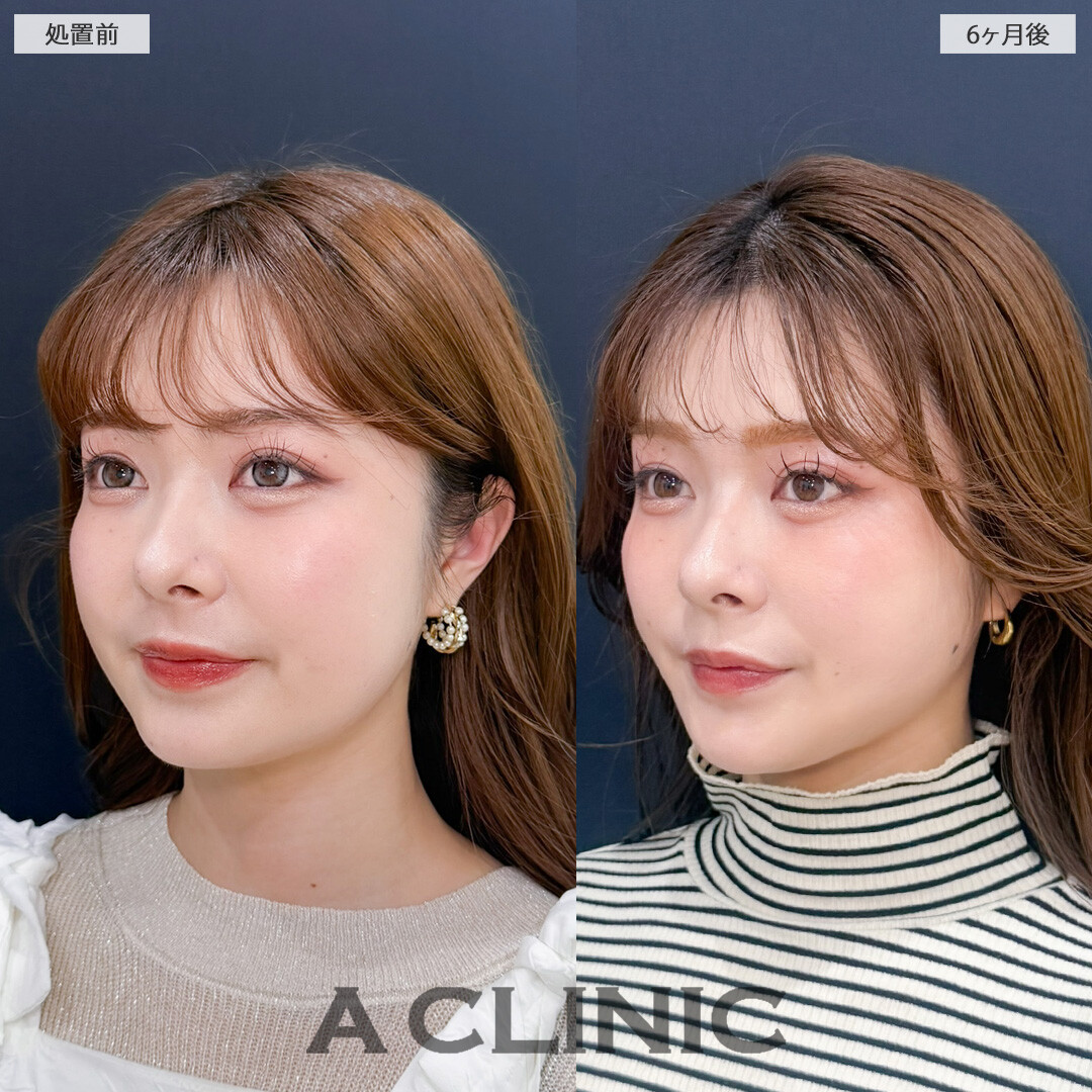 1day小顔脂肪吸引とバッカルファット除去術で永久不滅の小顔が完成しました！こちら処置前と6ヶ月後の症例です(20代女性)