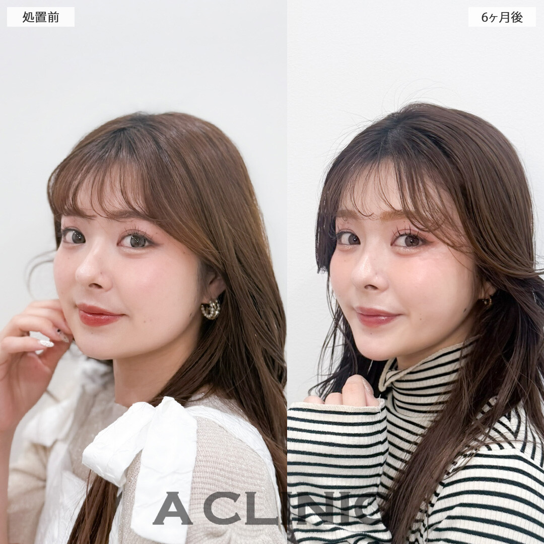 1day小顔脂肪吸引とバッカルファット除去術で永久不滅の小顔が完成しました！こちら処置前と6ヶ月後の症例です(20代女性)