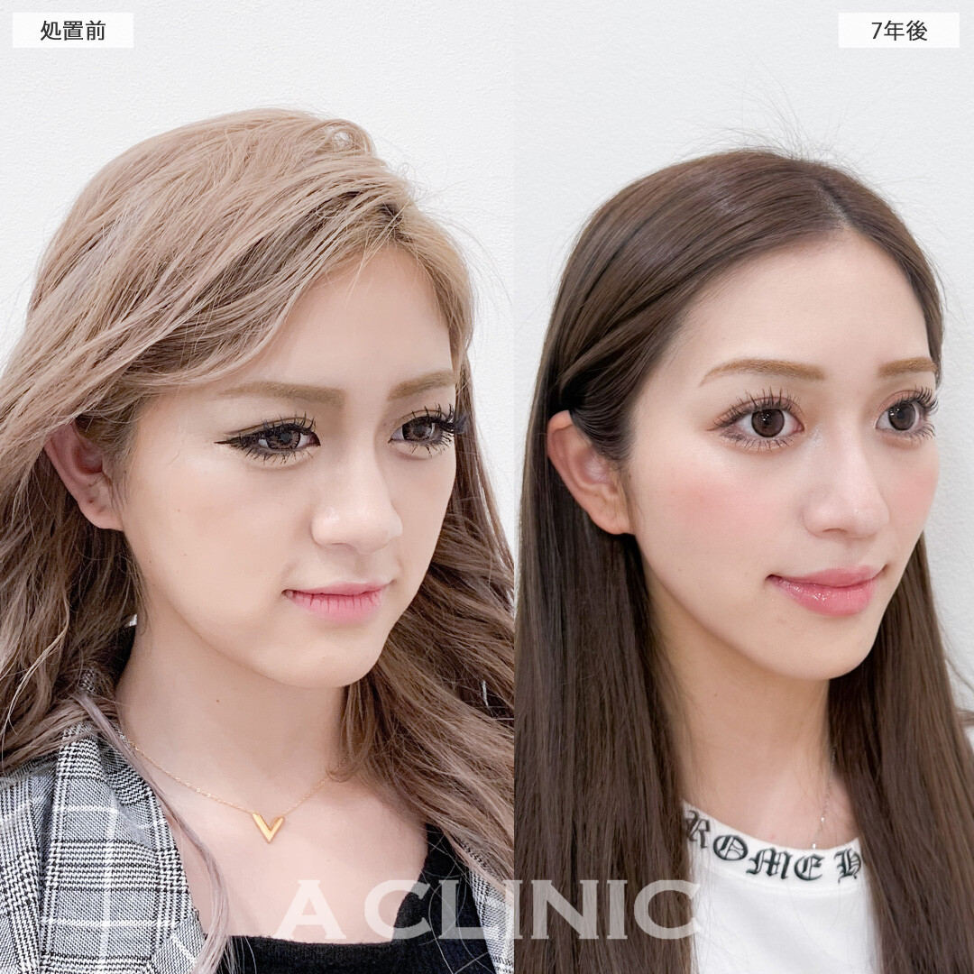 1day小顔脂肪吸引は7年たっても効果が持続！こちら処置前と7年後の症例です(20代女性)