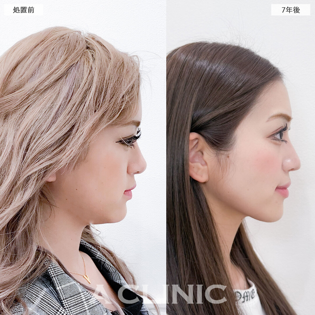 1day小顔脂肪吸引は7年たっても効果が持続！こちら処置前と7年後の症例です(20代女性)