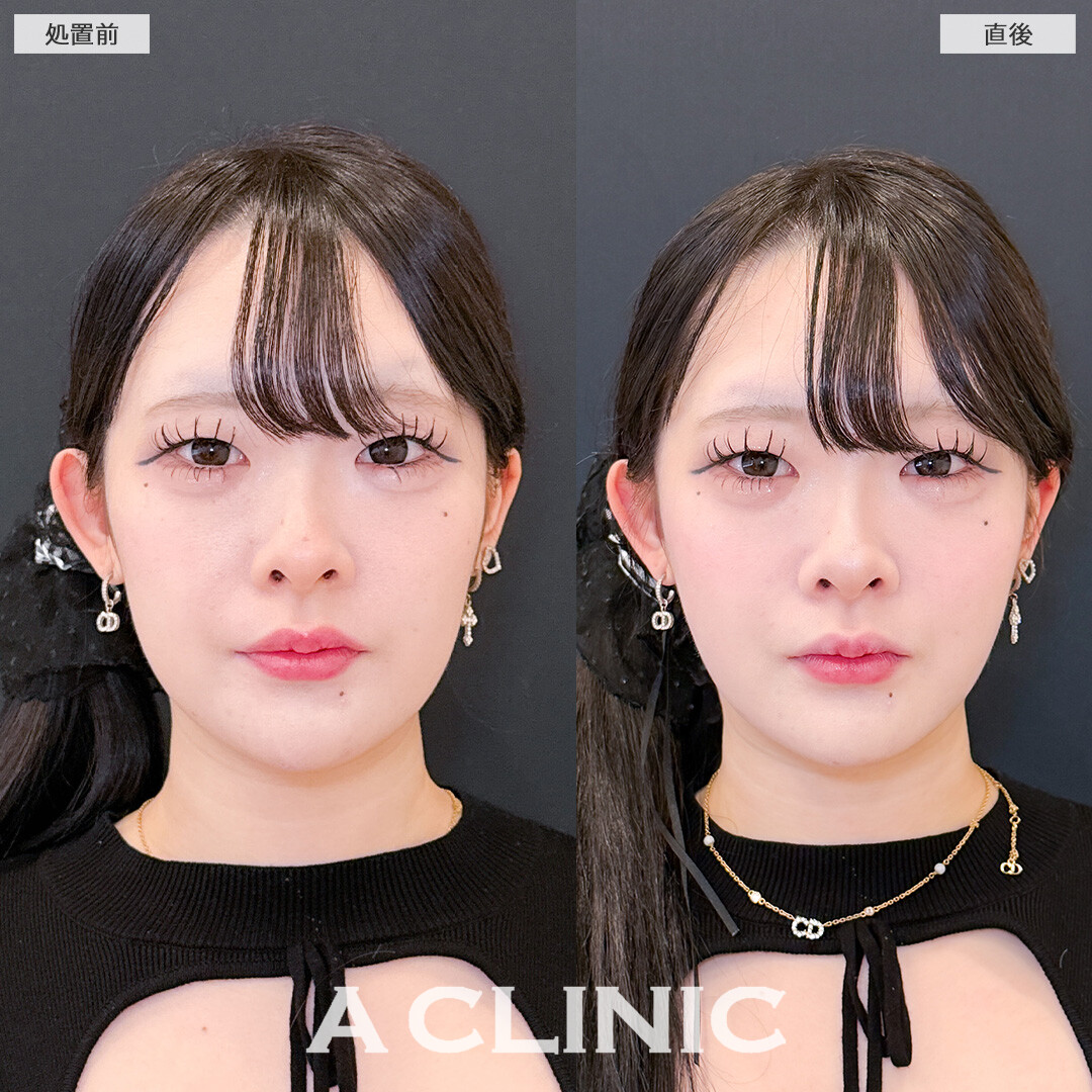1day小顔脂肪吸引でぼんやりフェイスラインもはっきりして小顔に！こちら処置前と直後の症例です(20代女性)