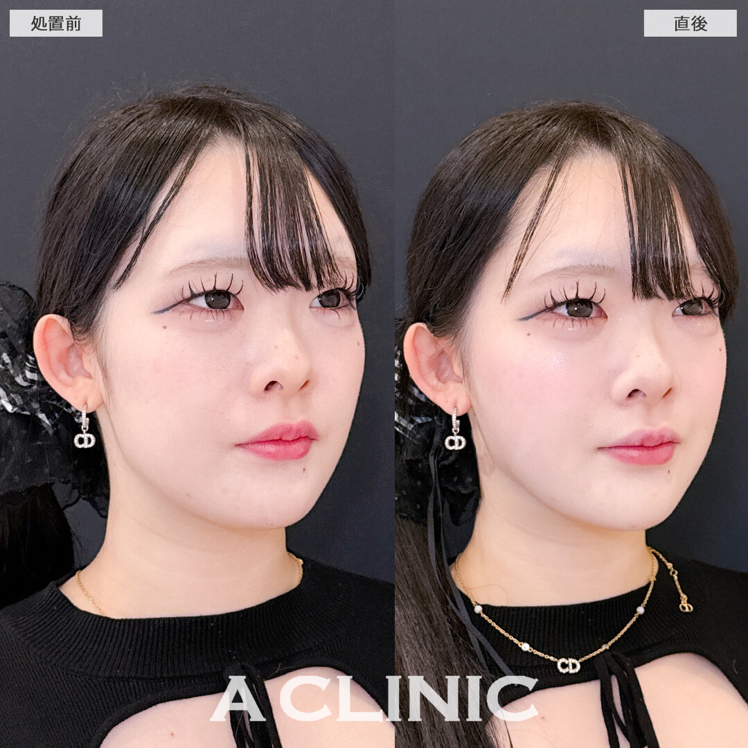 1day小顔脂肪吸引でぼんやりフェイスラインもはっきりして小顔に！こちら処置前と直後の症例です(20代女性)