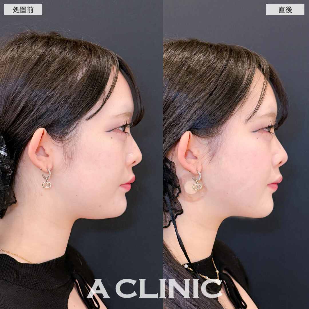 1day小顔脂肪吸引でぼんやりフェイスラインもはっきりして小顔に！こちら処置前と直後の症例です(20代女性)