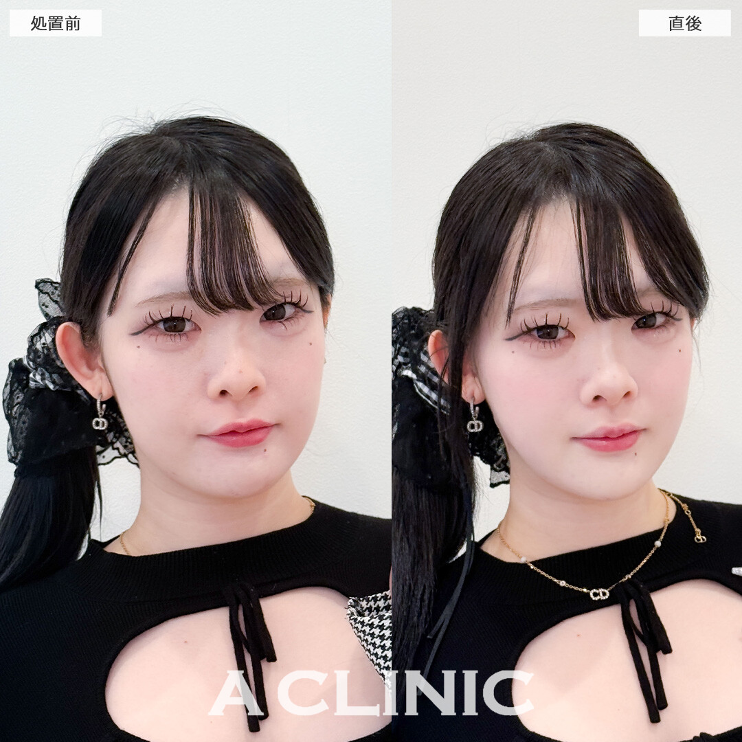 1day小顔脂肪吸引でぼんやりフェイスラインもはっきりして小顔に！こちら処置前と直後の症例です(20代女性)